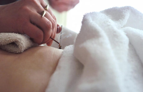 moxabustion being performed on a patient